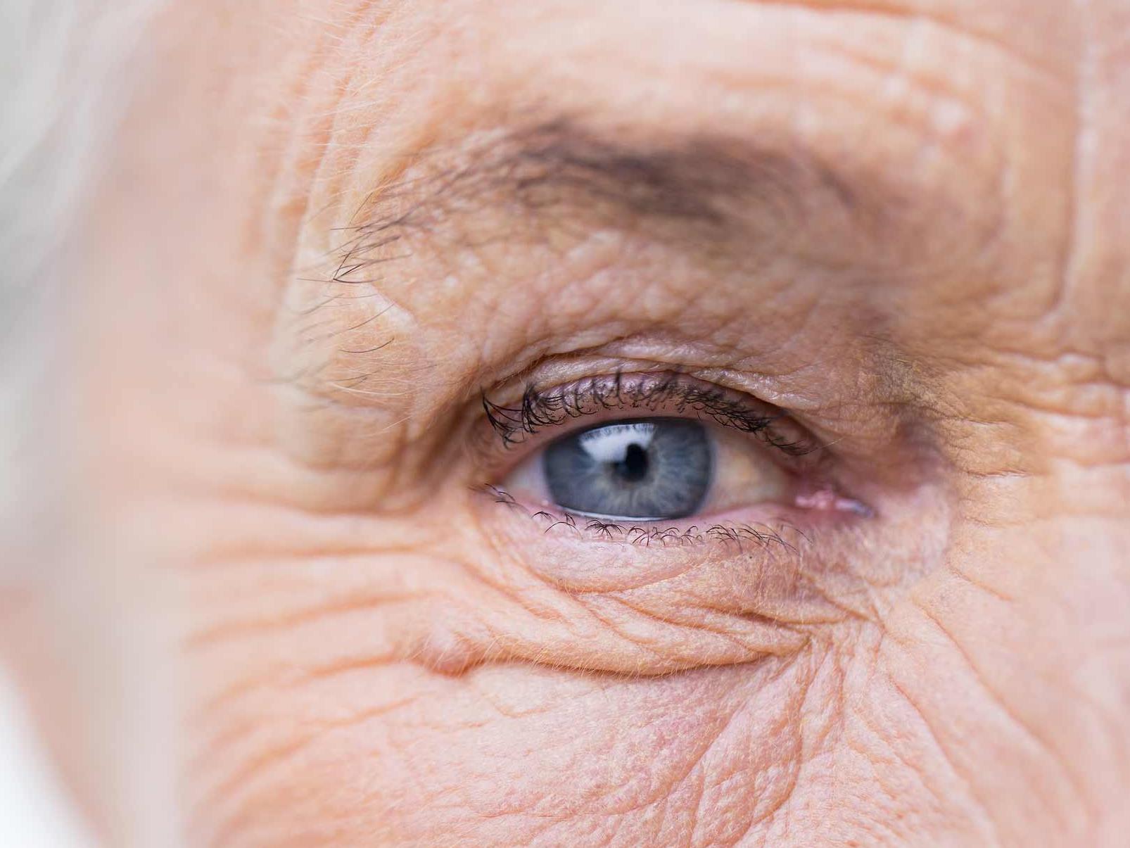 Obrázok zobrazuje detail nezdravého oka, ktorý ilustruje výskyt potenciálnych rizík očnej adnexy. 