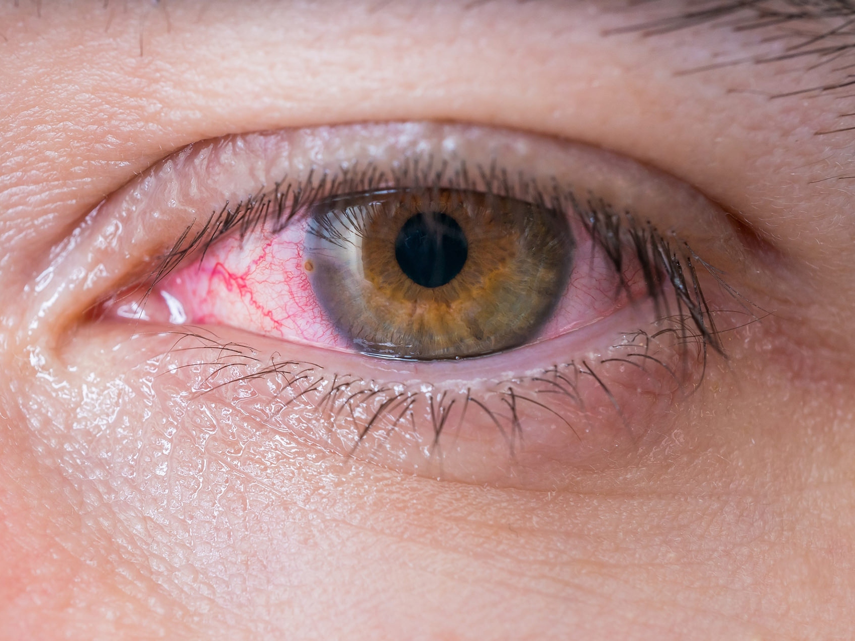 Obrázok zobrazuje detail nezdravého oka, ktorý ilustruje výskyt potenciálnych rizík pre oči. 